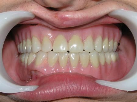 Покрывные зубные протезы3.jpg